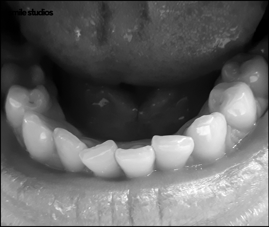 Invisalign Cost, Treatment Duration, and Pre-Treatment Checklist image 5