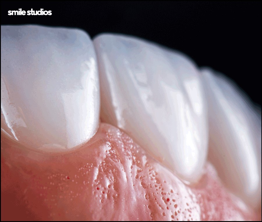 라미네이트 재시술 필요한 케이스, 주의사항 정리 관련 이미지 2