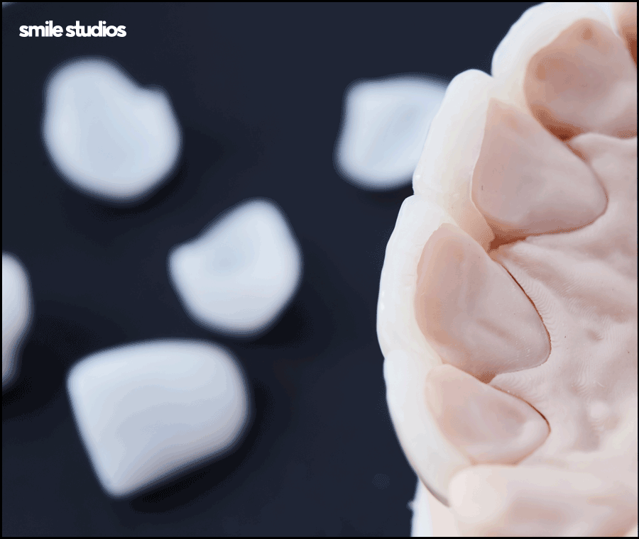 앞니 벌어짐 교정? 라미네이트? 케이스별 추천 방법 관련 이미지 6