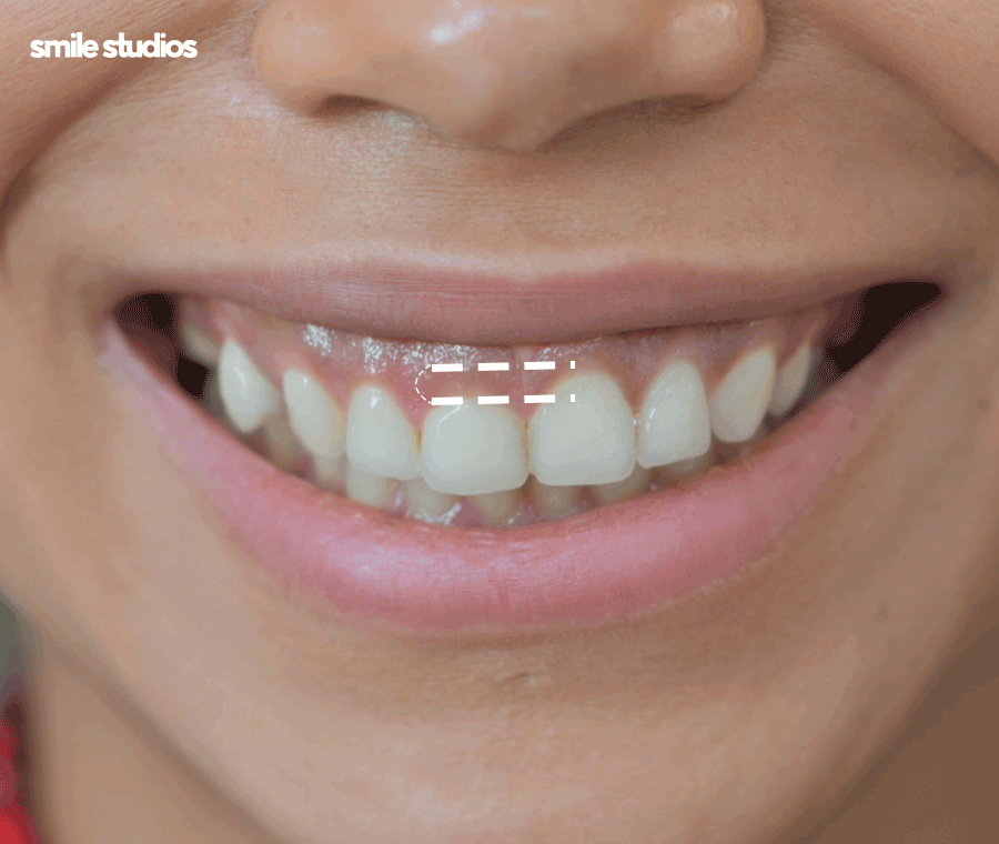 거미스마일 앞니 잇몸 과노출, 원인 및 보완 방법 관련 이미지 4