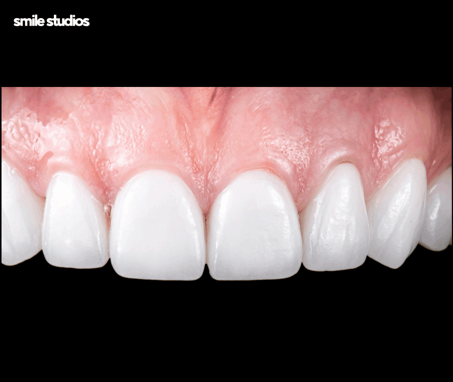 라미네이트 깨짐 대처, 어떻게 해야할까요? 방법 정리 관련 이미지 9