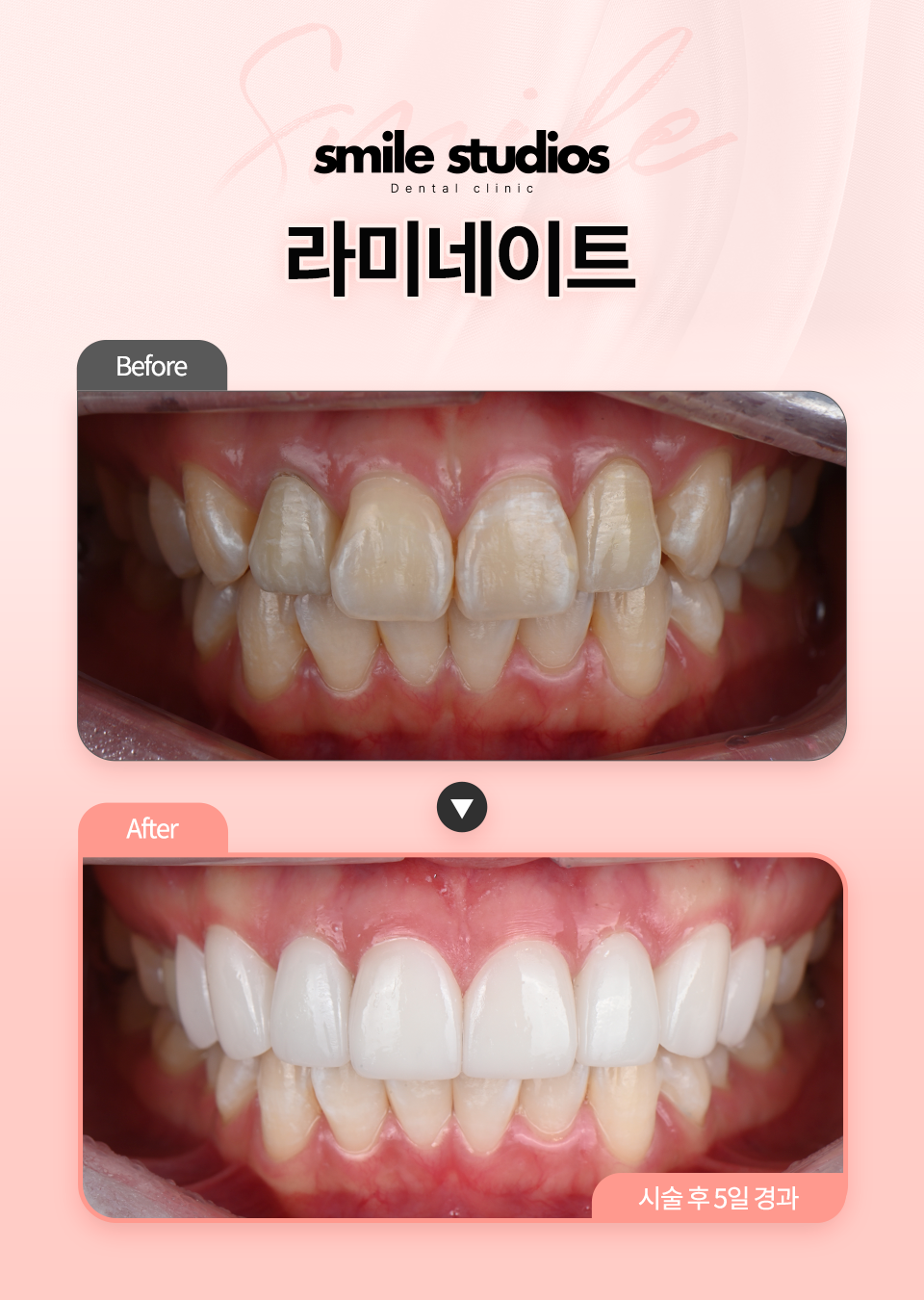 서울라미네이트, 후회 없는 선택 위한 결정적 차이! 관련 이미지 3