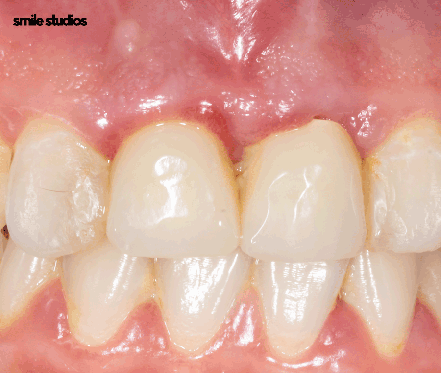 이빨깨짐 치료 치기를 놓치면 위험한 이유는? 관련 이미지 9