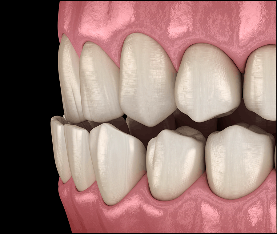 강남 인비절라인 찾는 이유, 치료 가능 범위는? 관련 이미지 5