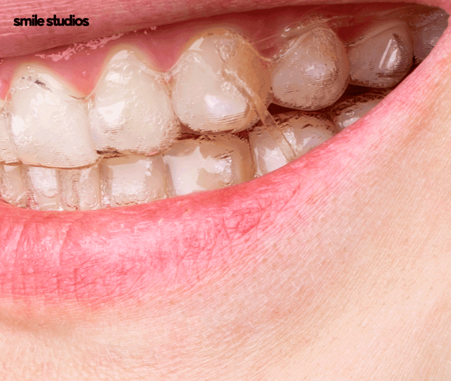 연예인 치아교정 심미성이 우수한 방법 2가지 관련 이미지 8