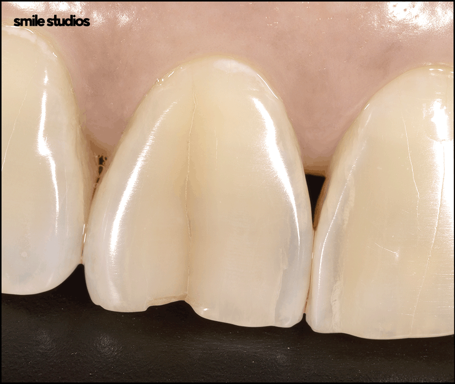 깨진이빨(앞니깨짐) 라미네이트 시술 효과는? 관련 이미지 4
