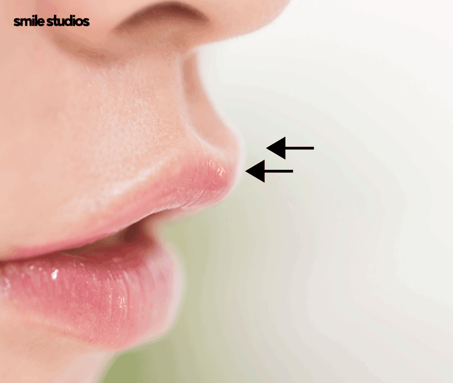 돌출입교정가격 기준 및 효과, 방법 파헤치기 관련 이미지 4