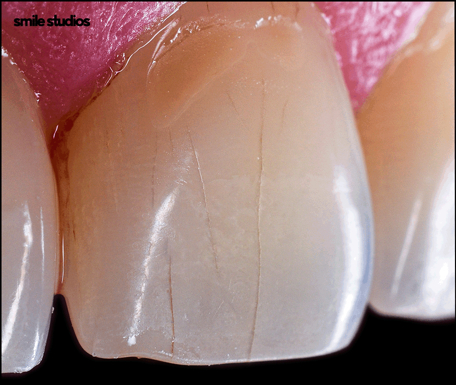 학동역치과 라미네이트 시작 전 확인해야 할 체크사항 관련 이미지 5