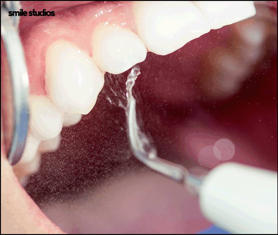 신사동치과 라미네이트 수명 늘리는 방법 A to Z 관련 이미지 8