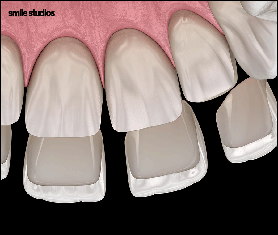 연예인라미네이트 선호도가 높은 이유, 효과 관련 이미지 8