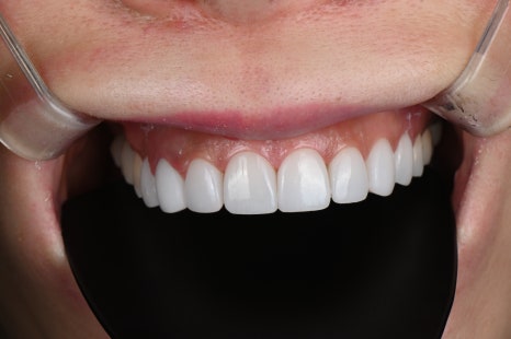 신사역치과 라미네이트 후 이미지 변화? 자연스러움의 비밀 공개! 관련 이미지 9