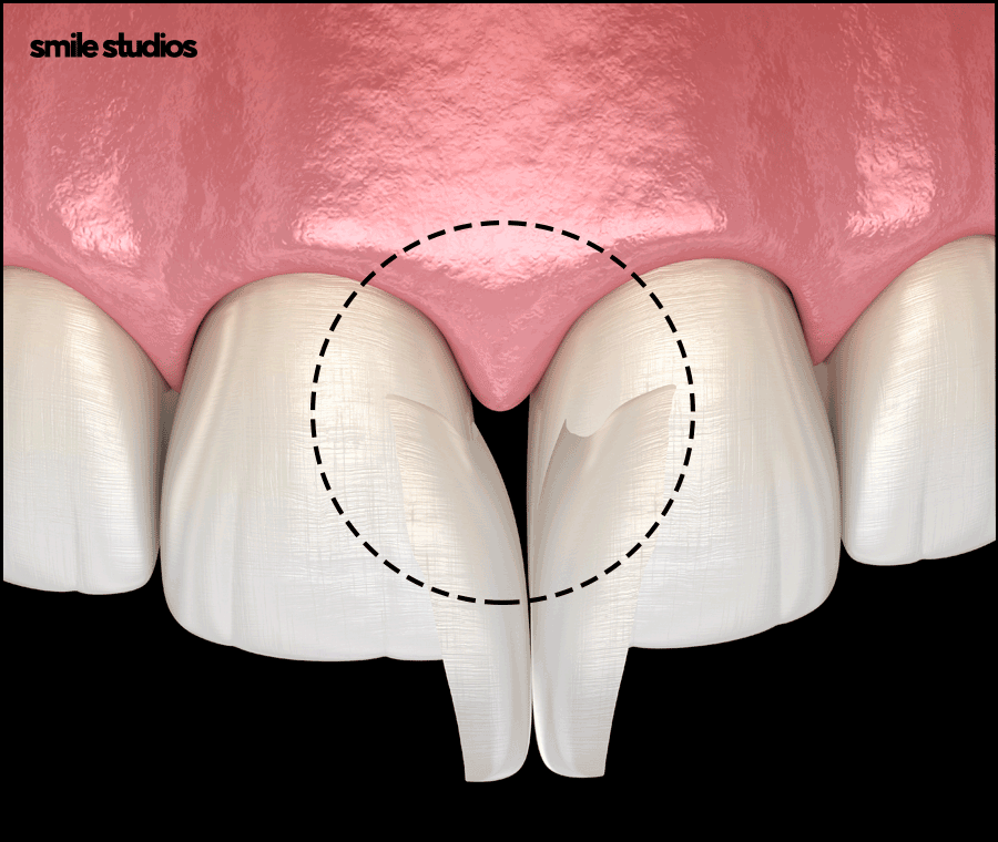 블랙트라이앵글 치료 적합한 방법 알아보기 관련 이미지 4