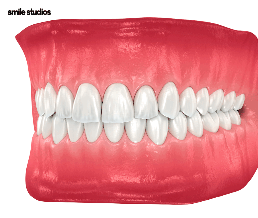 돌출입교정가격 기준 및 효과, 방법 파헤치기 관련 이미지 8