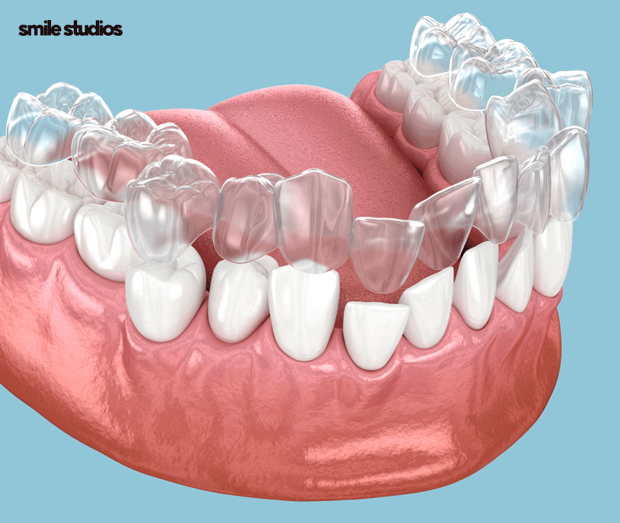 부정교합 교정기(투명) 종류 및 특징 알아보기 관련 이미지 5