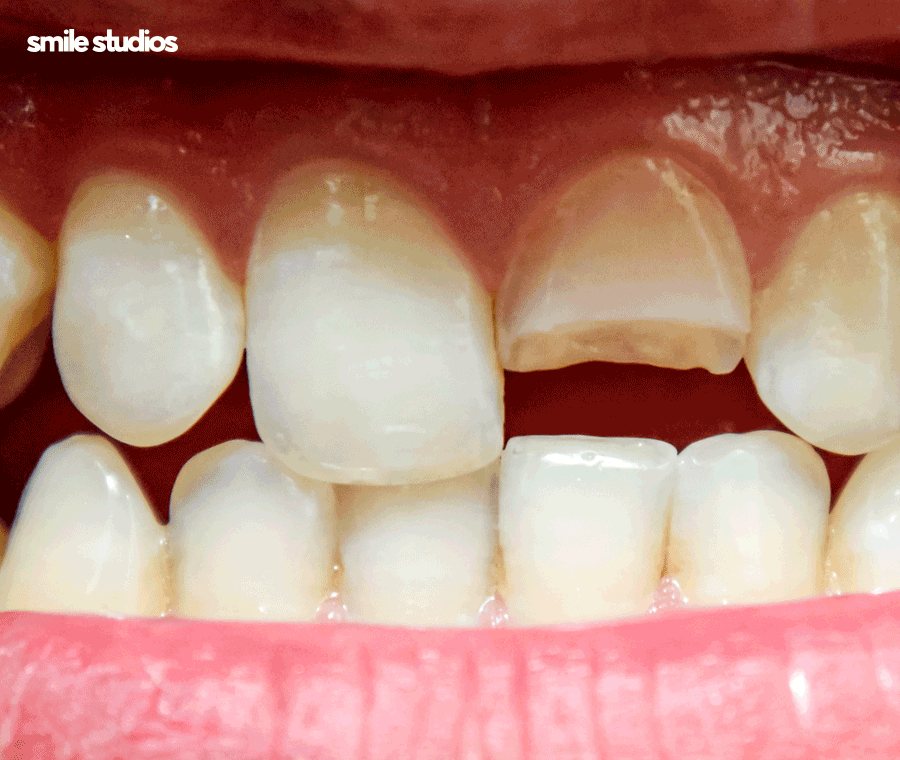 앞니 살짝 깨짐 라미네이트로 대처 가능한 수준은? 관련 이미지 5