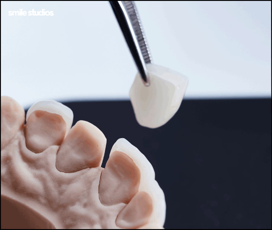 깨진이빨(앞니깨짐) 라미네이트 시술 효과는? 관련 이미지 8