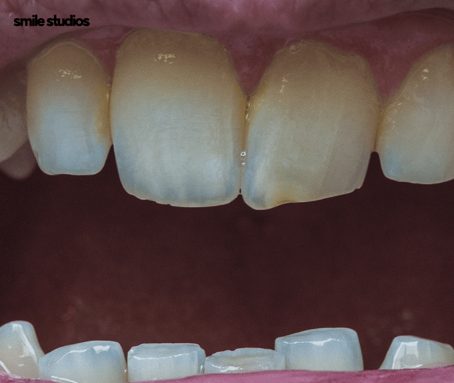 강남역 교정치과 삐뚠 앞니, 부분 치료 괜찮을까? 관련 이미지 4