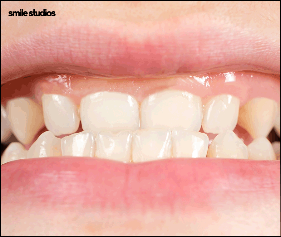 잠원동치과 치아교정 관련 이미지 2