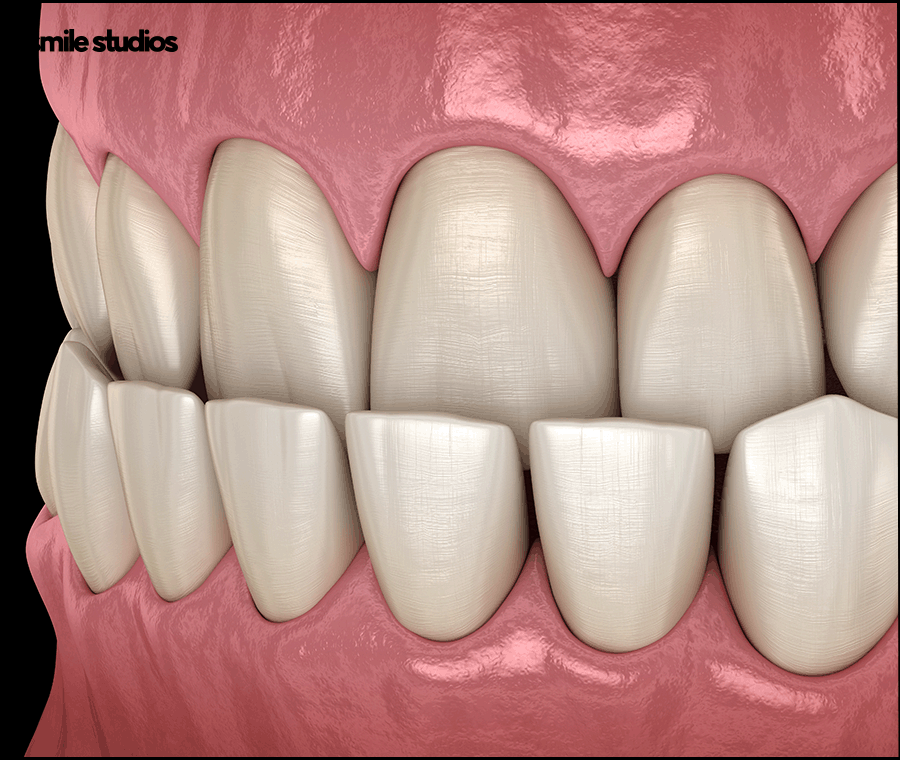 잠원동치과 투명교정 나노라이너, 인비절라인 비교 관련 이미지 9