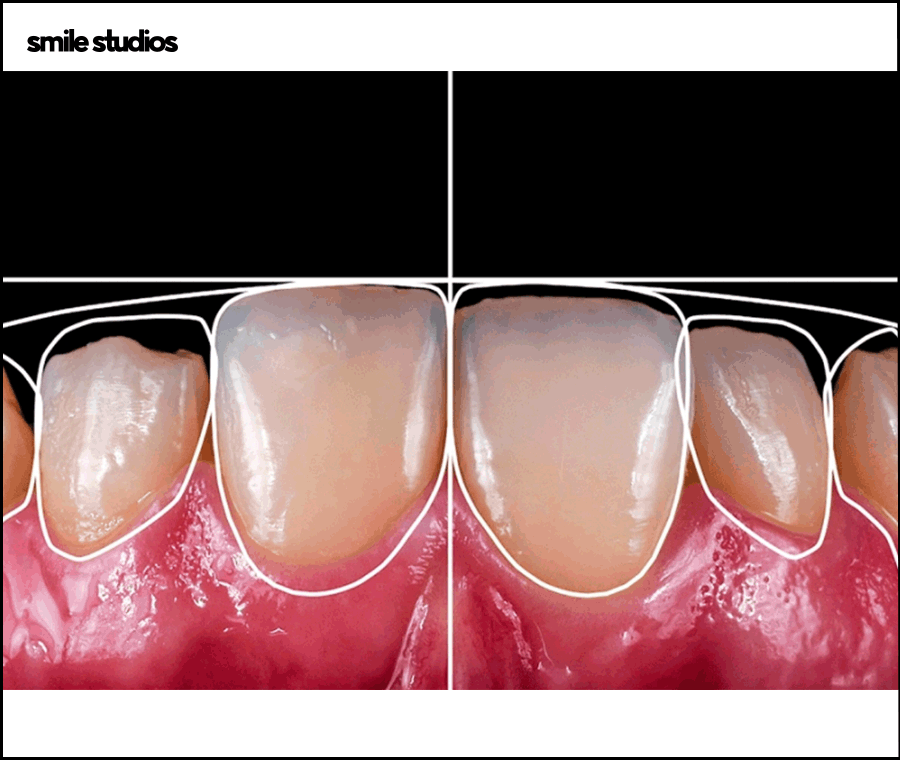잠원동치과 치아교정 관련 이미지 7