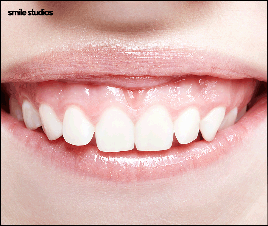 거미스마일 미소의 결함, 해결 방법 ft. 라미네이트 관련 이미지 2