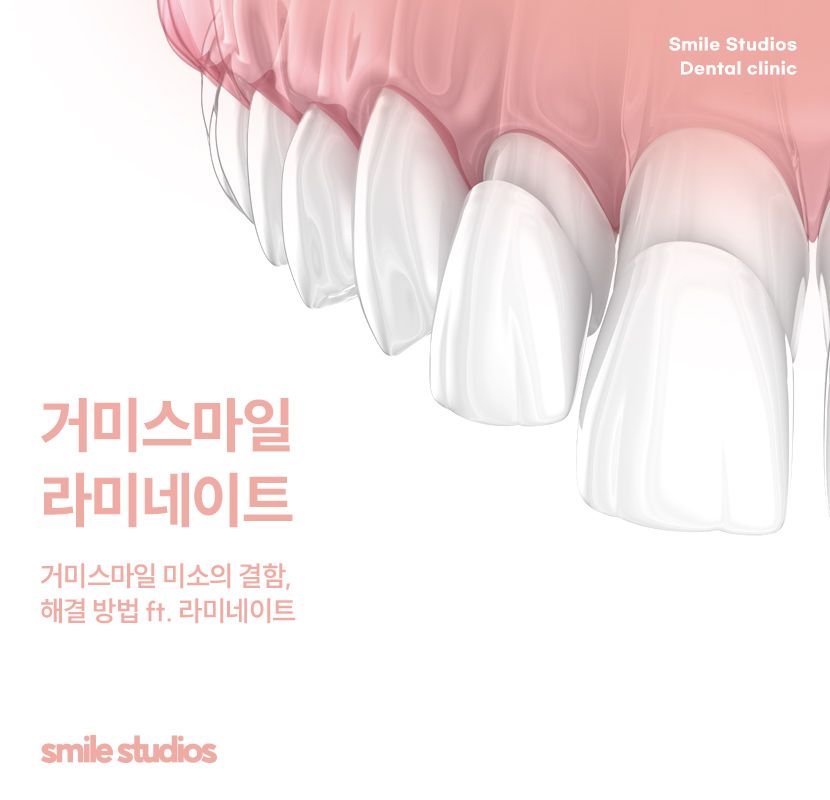 거미스마일 미소의 결함, 해결 방법 ft. 라미네이트 관련 이미지 1