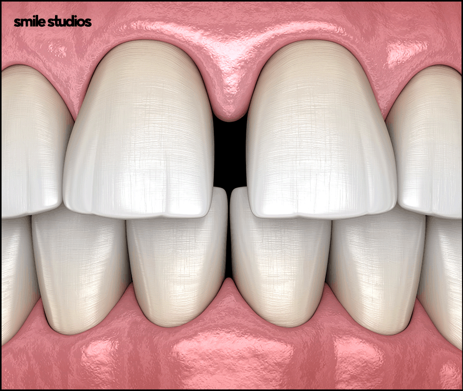 Why Are Veneers Preferred for Gaps Between the Front Teeth? image 3