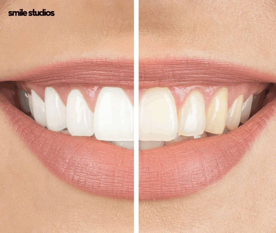 라미네이트 변색, 발생하는 이유, 시점, 대처 방법 관련 이미지 5