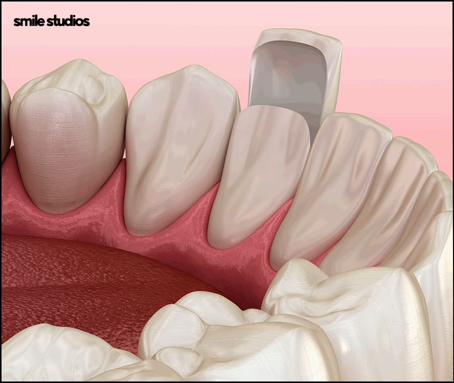 학동역치과 라미네이트 시작 전 확인해야 할 체크사항 관련 이미지 8