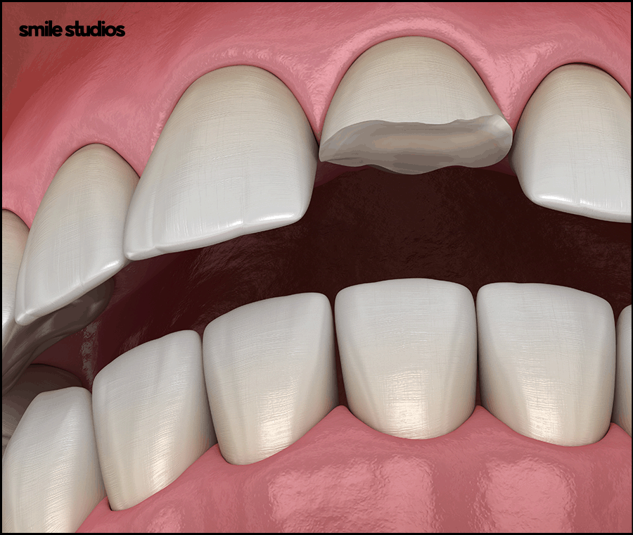 앞니 살짝 깨짐 라미네이트로 대처 가능한 수준은? 관련 이미지 4