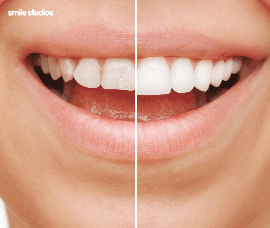 무삭제 라미네이트 효과, 원리, 선호하는 이유 A to Z 관련 이미지 4