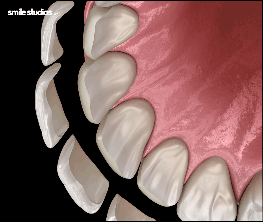 최소삭제 라미네이트 성공하려면 체크할 점 관련 이미지 3