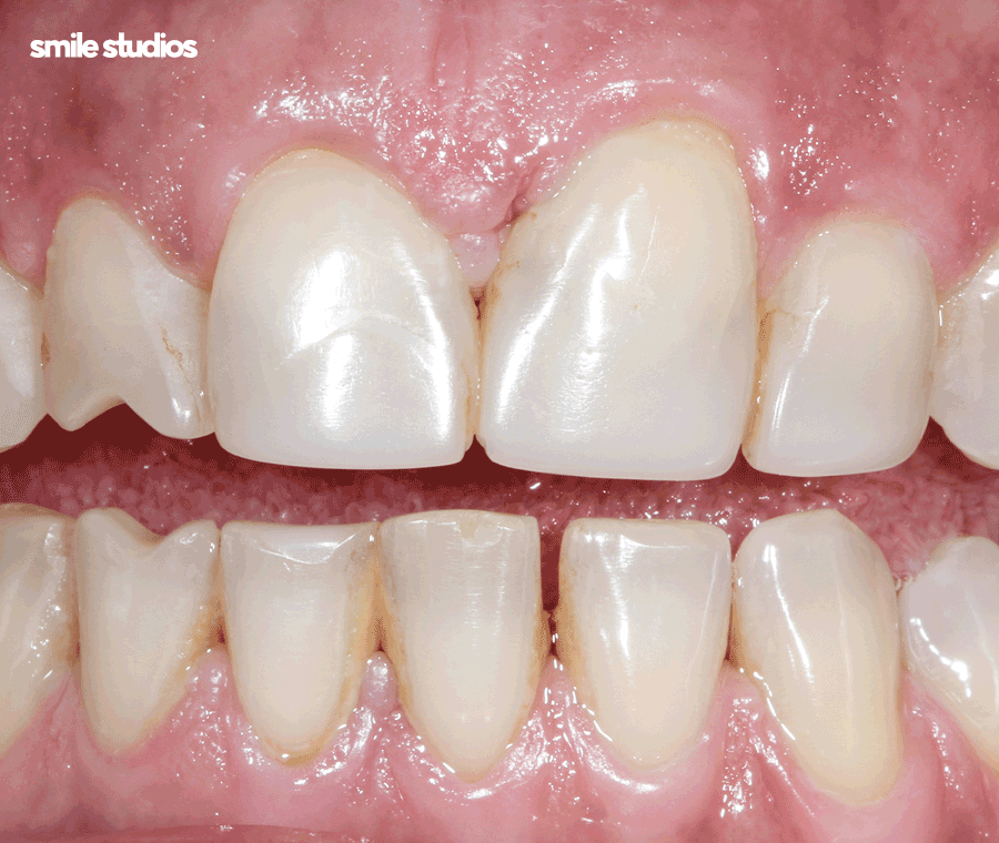 압구정 라미네이트 성공적인 결과를 만드는 핵심은? 관련 이미지 4