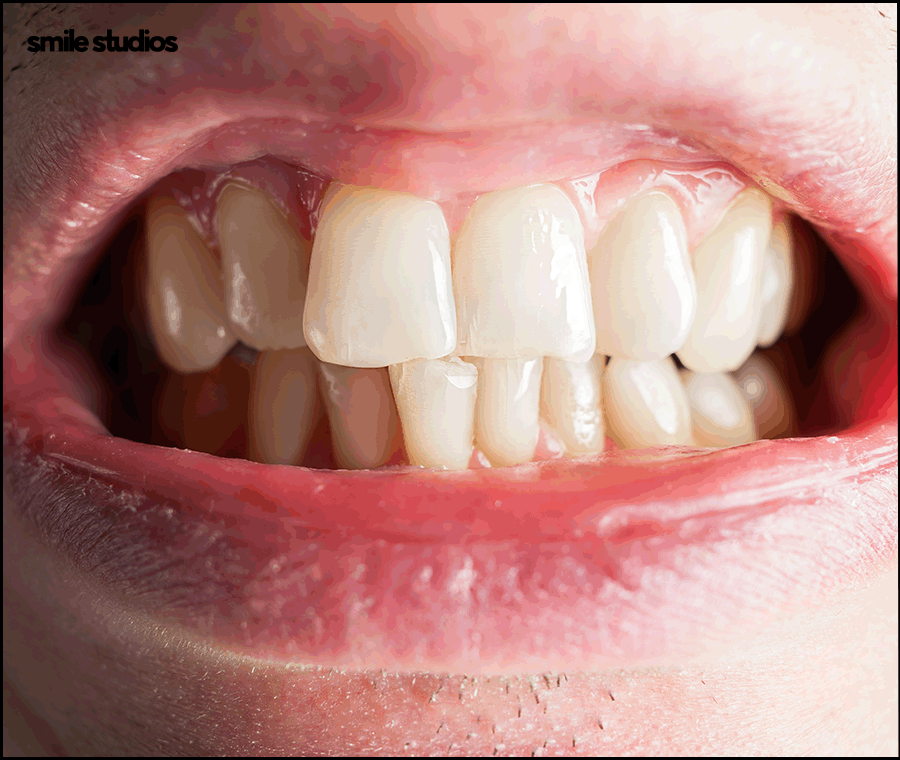 Invisalign Cost, Treatment Duration, and Pre-Treatment Checklist image 4