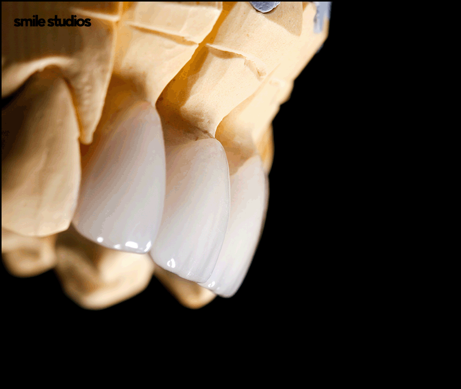 김영경 원장이 전하는 무삭제 라미네이트 A to Z 관련 이미지 6