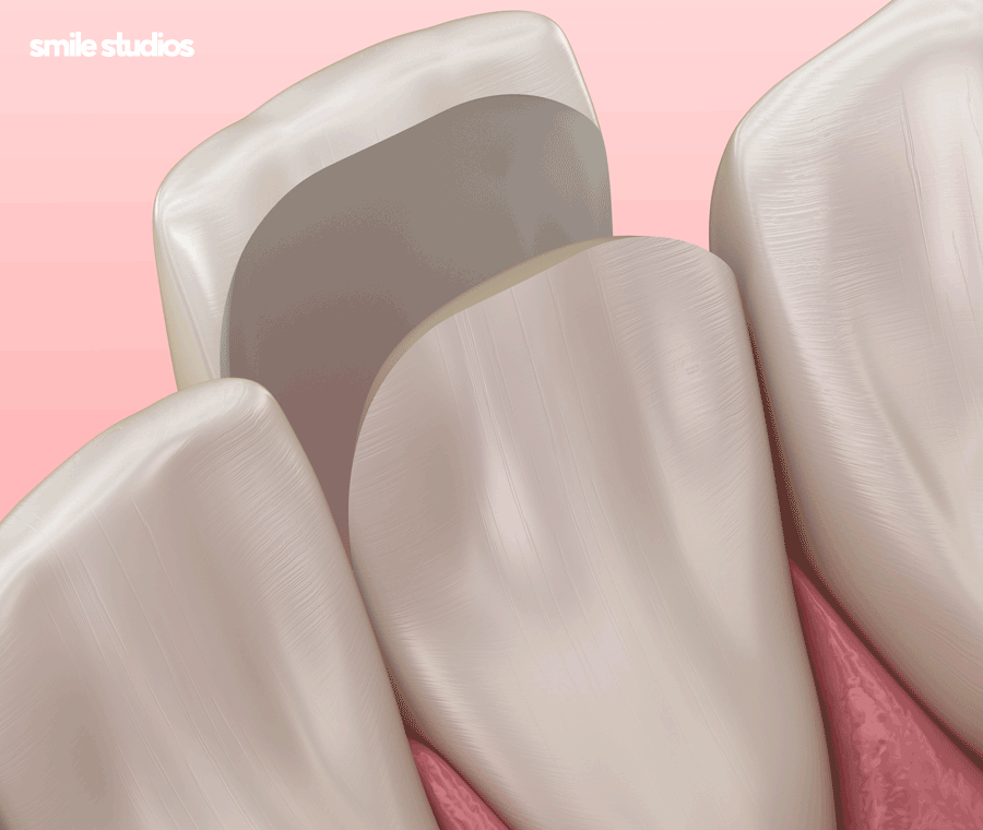 거미스마일 앞니 잇몸 과노출, 원인 및 보완 방법 관련 이미지 6