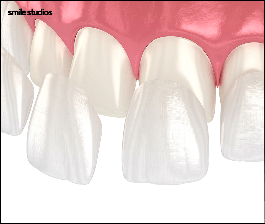 Why Are Veneers Preferred for Gaps Between the Front Teeth? image 6