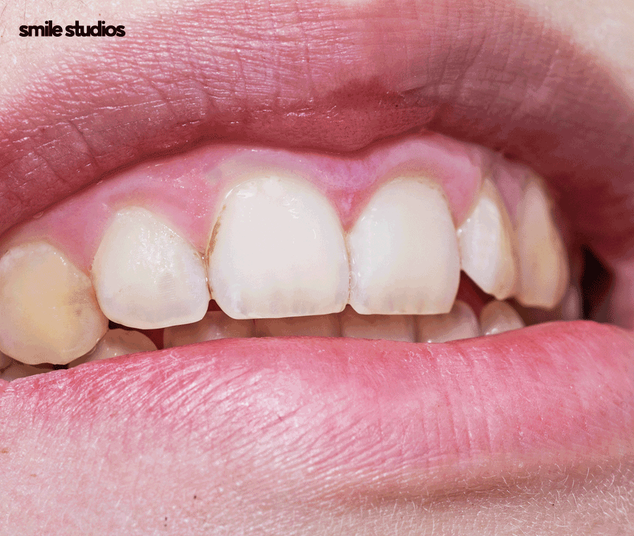 옥니 교정 필요한 이유, 발생 원인, 방법 파헤치기 관련 이미지 2