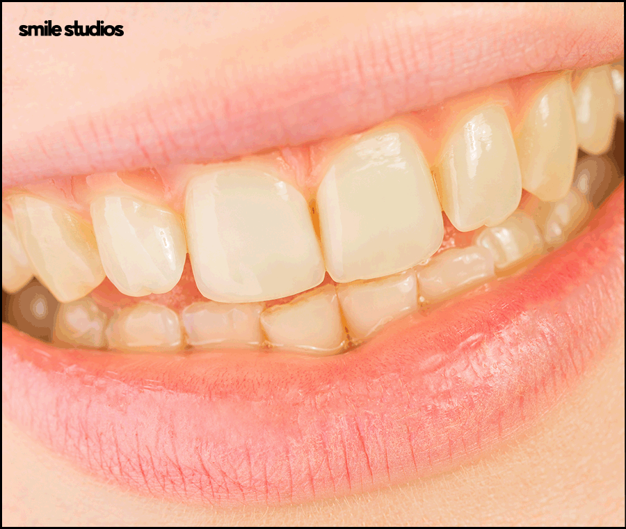 앞니무삭제라미네이트 핵심이 되는 사항은? 관련 이미지 8