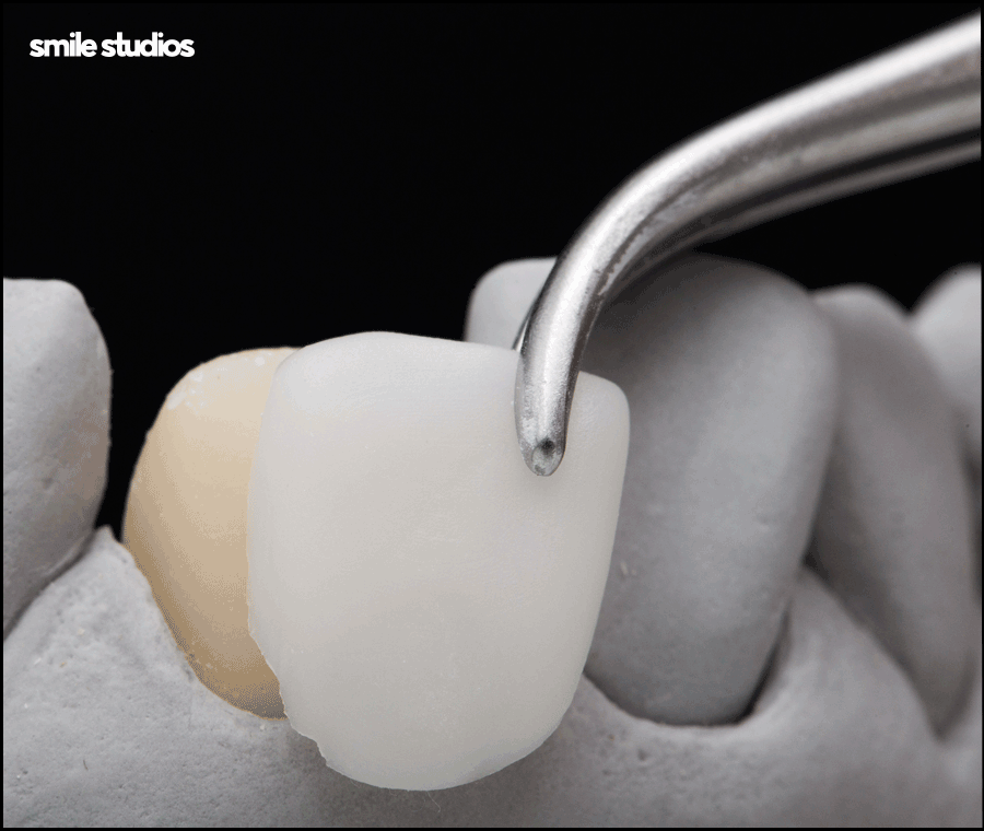 강남무삭제라미네이트 시작 전 확인할 핵심 포인트 관련 이미지 8