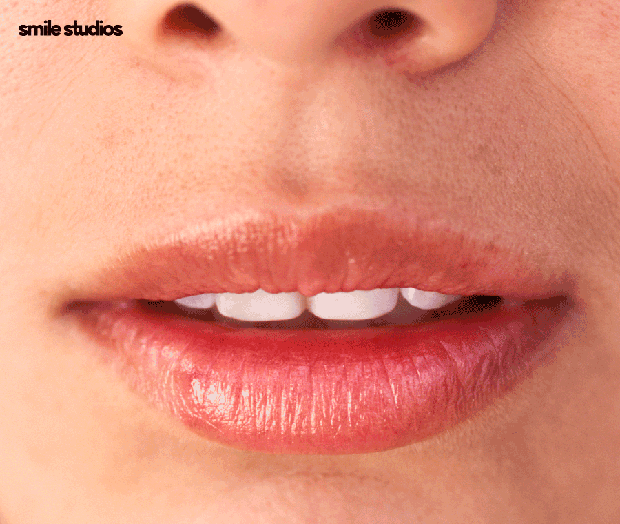 뻐드렁니 교정 성공적인 결과를 위한 key 확인 관련 이미지 8