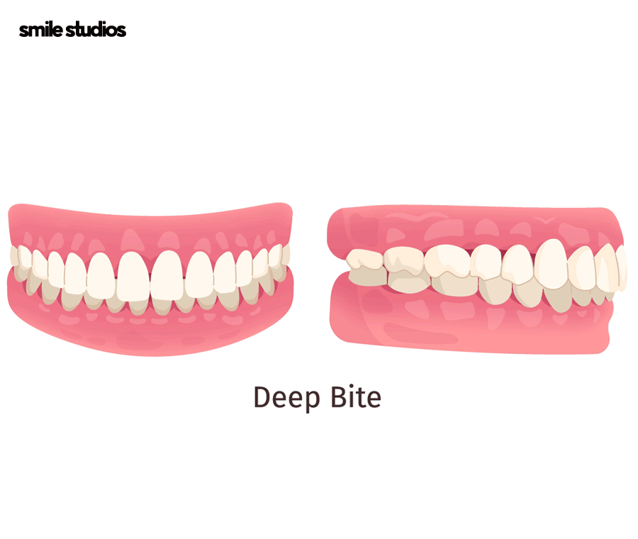 과개교합 교정을 위한 나노라이너 특징 총 정리 관련 이미지 4