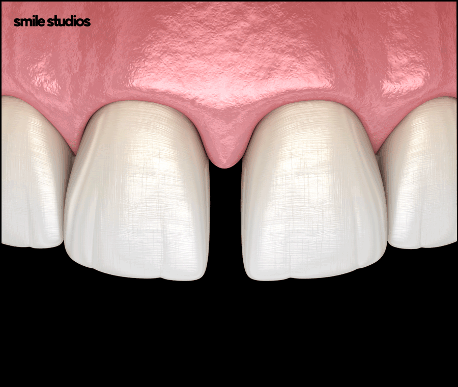 이빨사이벌어짐 부분 교정, 라미네이트 선택 Tip 관련 이미지 2