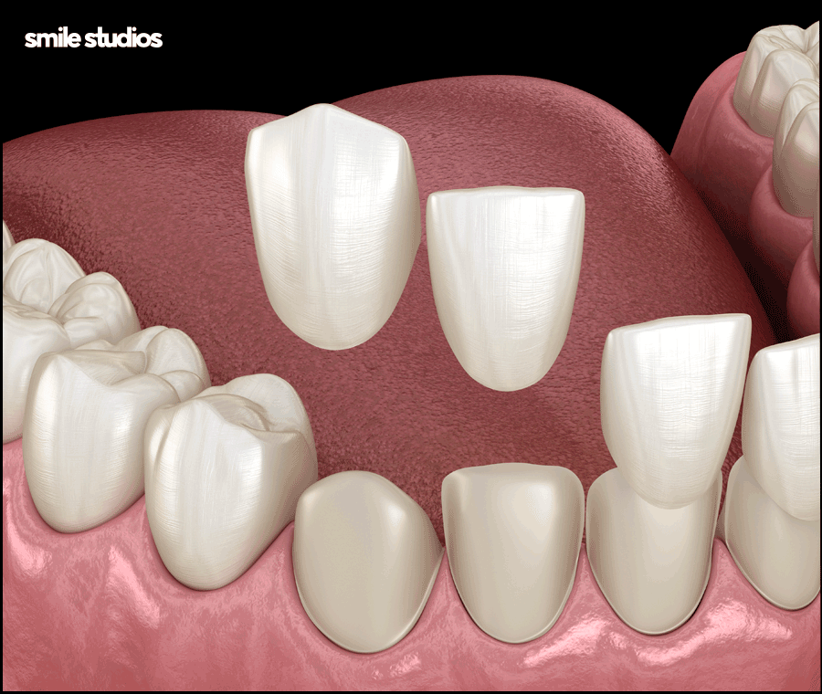 역삼역 치과, 치아 파임 증상 라미네이트 효과는? 관련 이미지 5
