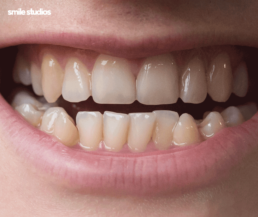 중년치아교정 소요 시간 포함 시작 전 체크할 사항 관련 이미지 5