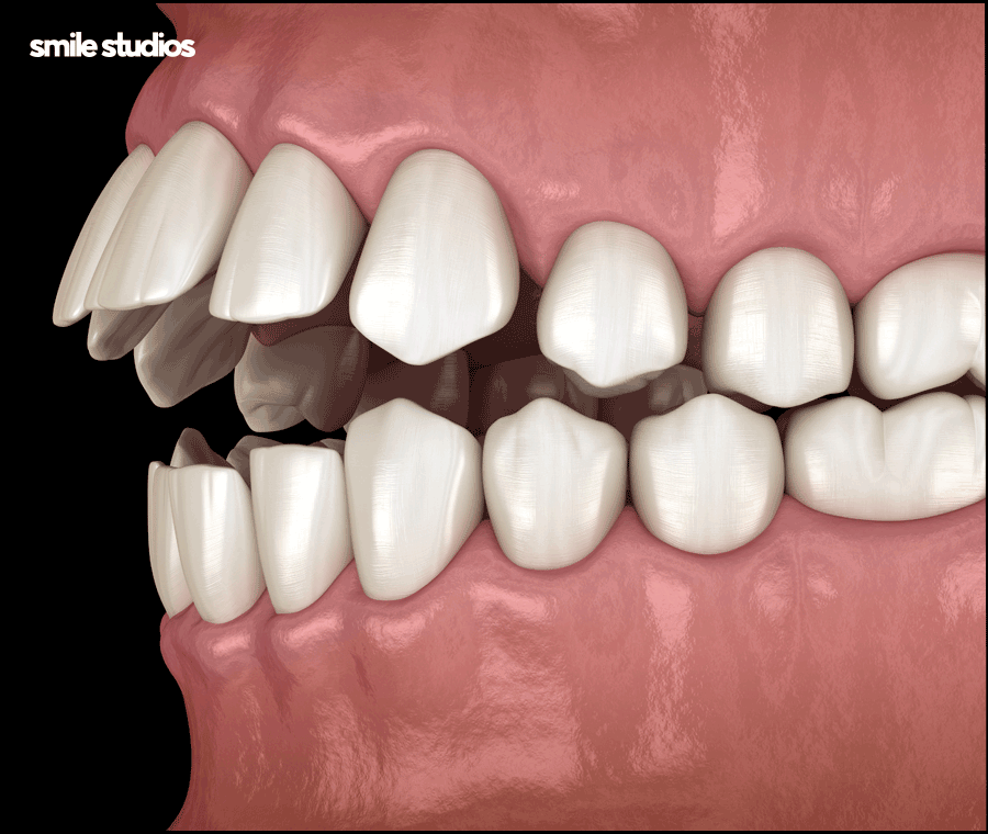 역삼역치과 인비절라인, 브라켓과 차이점 알아보기 관련 이미지 11