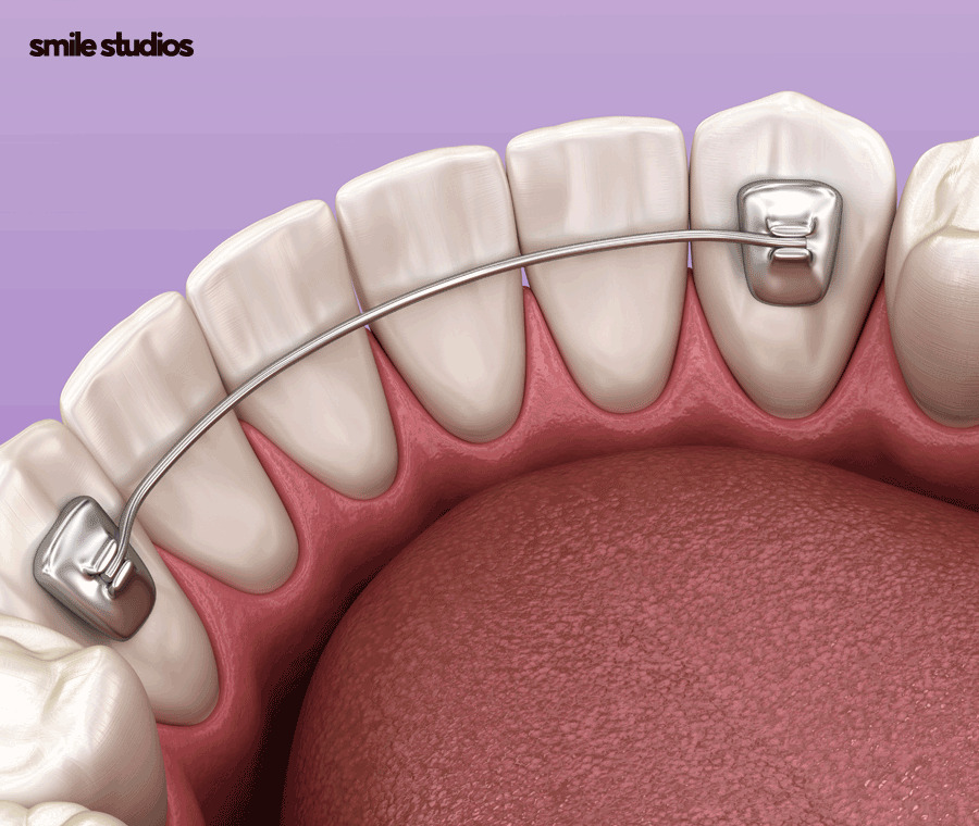 인비절라인 유지장치 착용 기간, 주의사항 알아보기 관련 이미지 6
