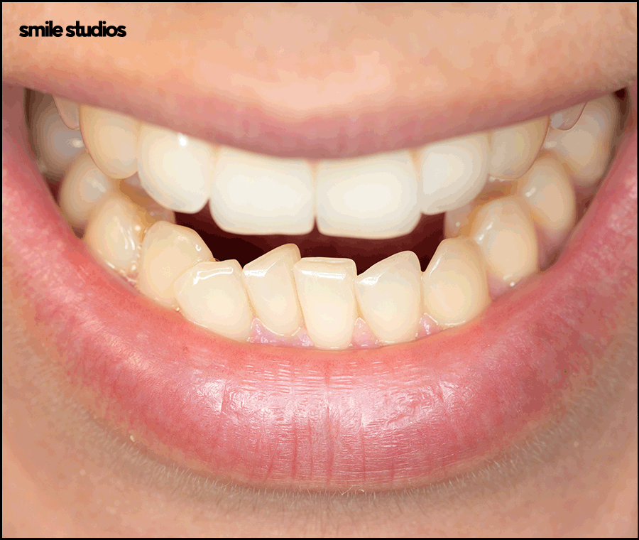 인비절라인 통증이 적은 결정적인 이유 알아보기 관련 이미지 9