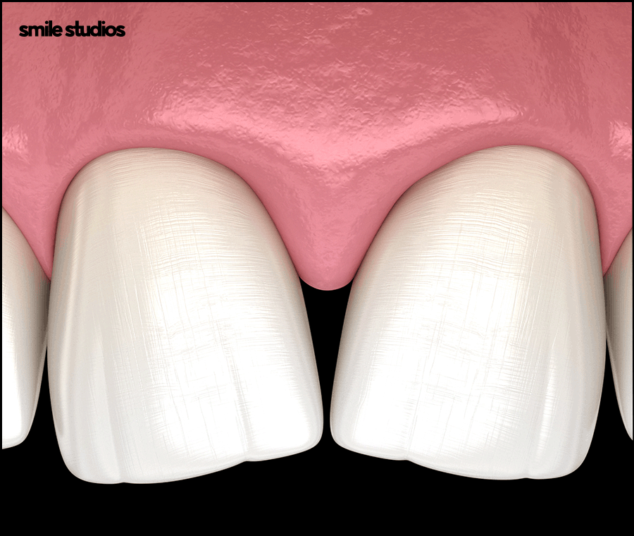 앞니 블랙트라이앵글 보완을 위한 라미네이트 효과 관련 이미지 2