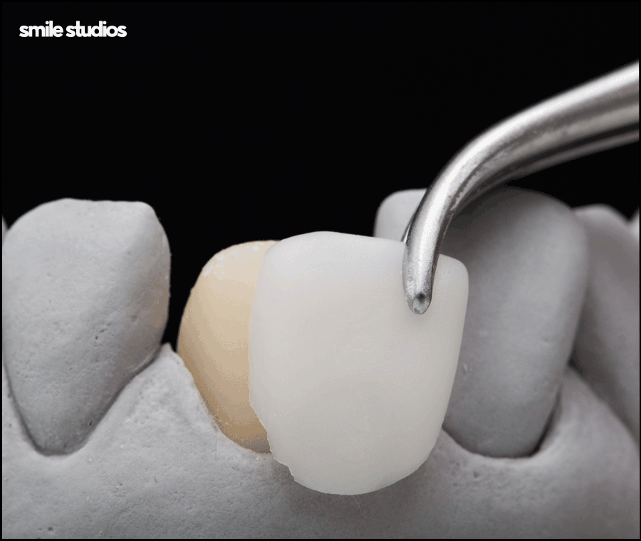 심미보철 가격, 기준, 시술 전 확인사항 총 정리 관련 이미지 5